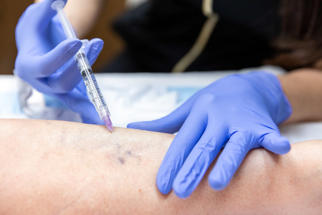 sclerotherapy treatment process photo of one of our two cosmetic vein treatments in Rogers