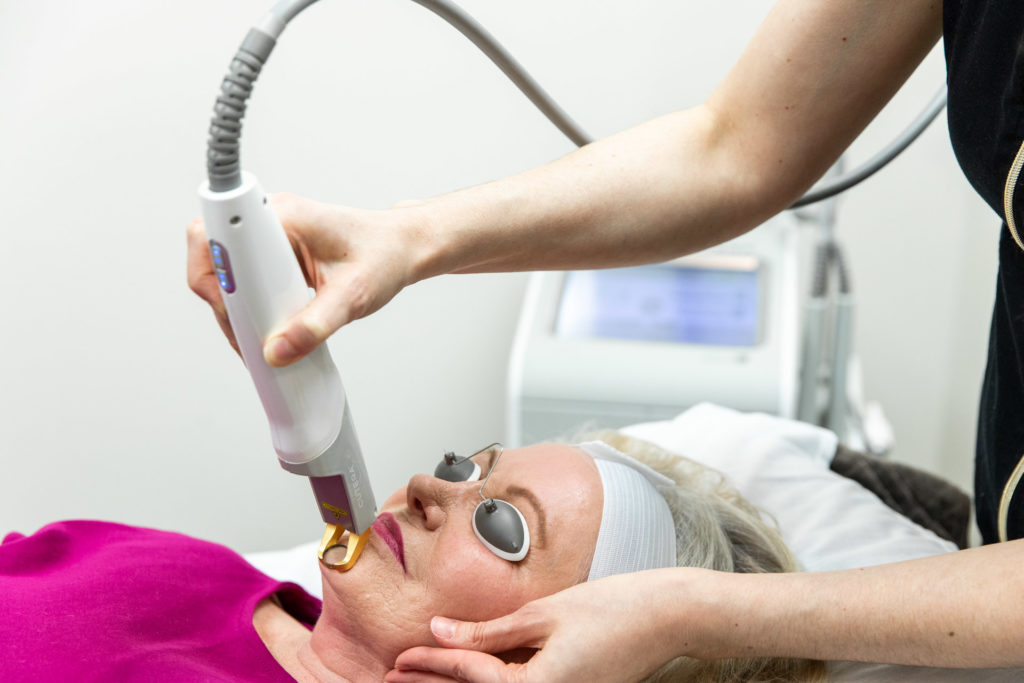 Rosacea laser treatment in Rogers