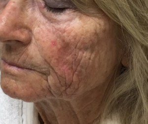 before image of a woman's skin before a mature skin treatment in Rogers