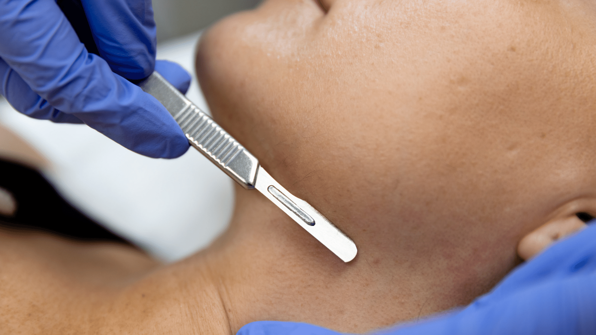 photo of the treatment process for dermaplaning in Rogers