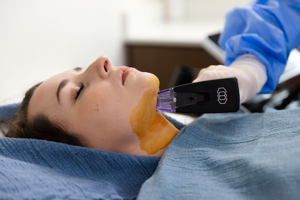 woman lying on a treatment bed receiving FaceTite to her double-chin as part of a non surgical facelift in Arkansas