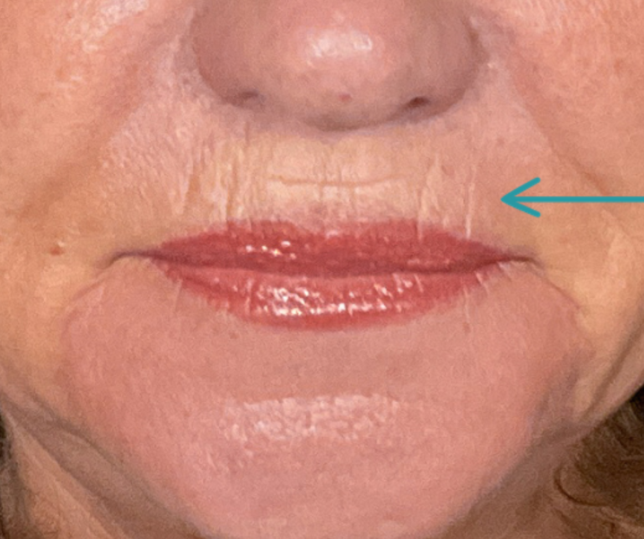 fibroblasting upper lip